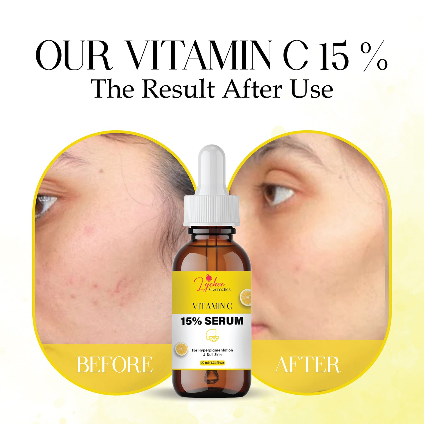 Vitamin C Face Serum for Glowing Skin | Brightening & Anti-Aging Serum with Hyaluronic Acid & Vitamin E | Fades Dark Spots, Evens Skin Tone, Reduces Fine Lines | For Men & Women – 30ml